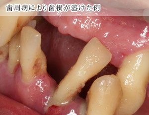 歯周病により歯根が溶けてしまった歯の例